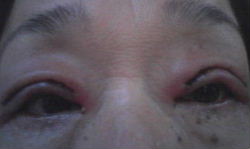 眼瞼下垂術後１日目.JPG