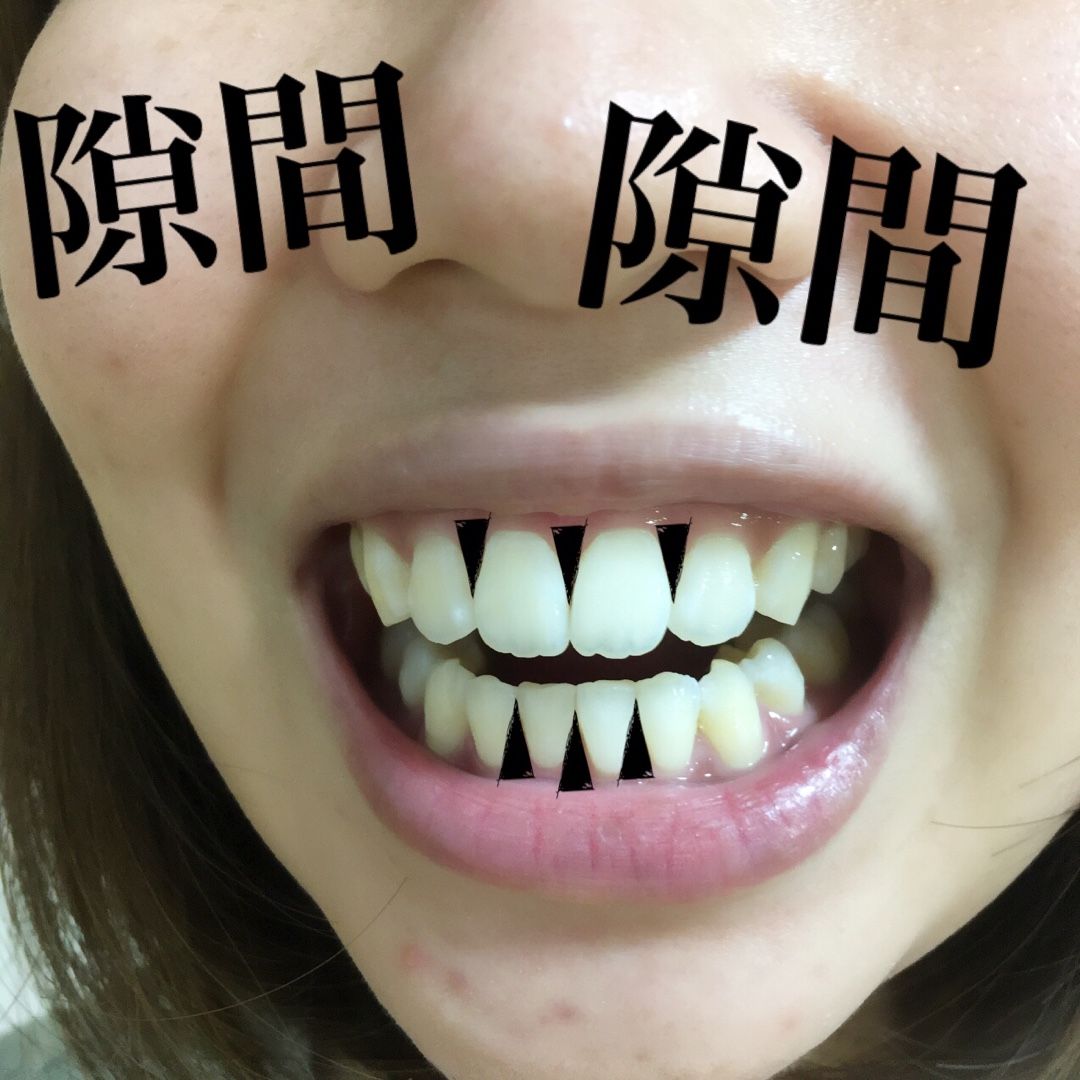 歯茎