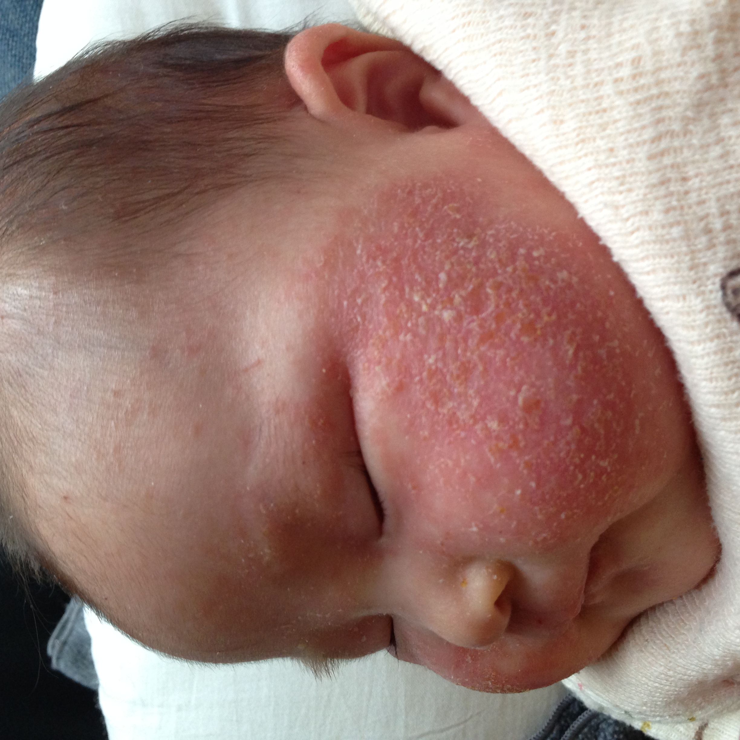 乳児湿疹を放置するとアトピーや食物アレルギーや花粉症になる 年の差育児日記 兄と妹 7歳差 楽天ブログ