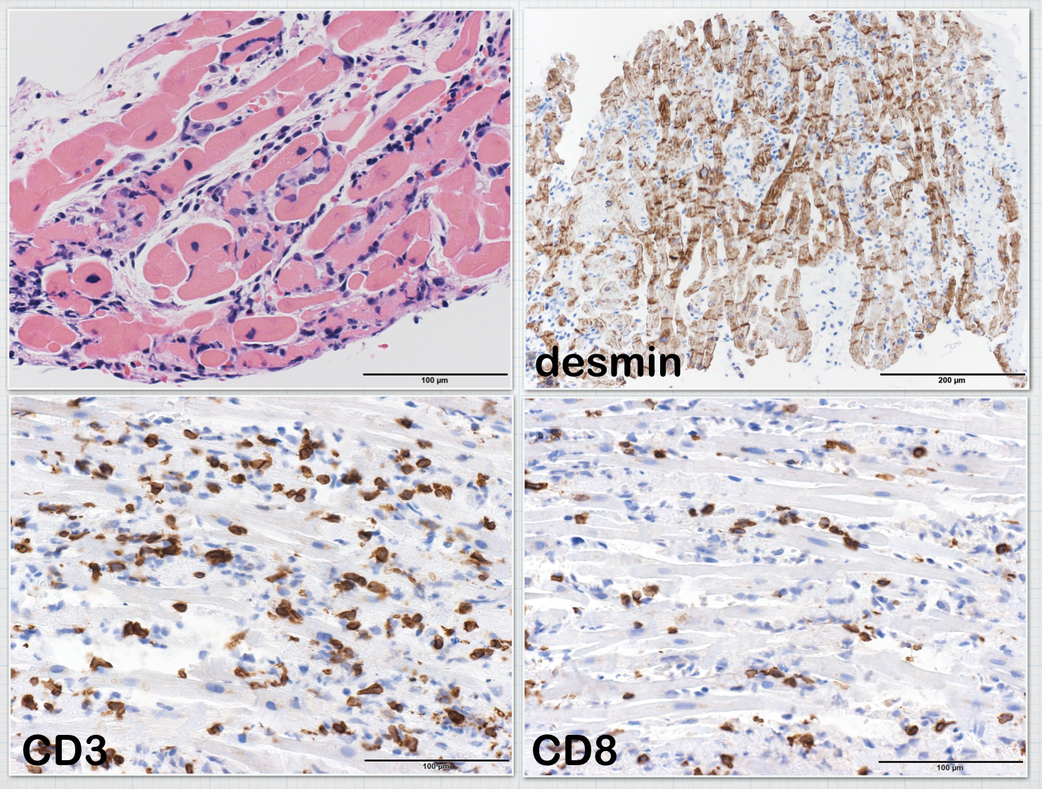 Acute Viral Myocarditis 病理検査の玉手箱 楽天ブログ