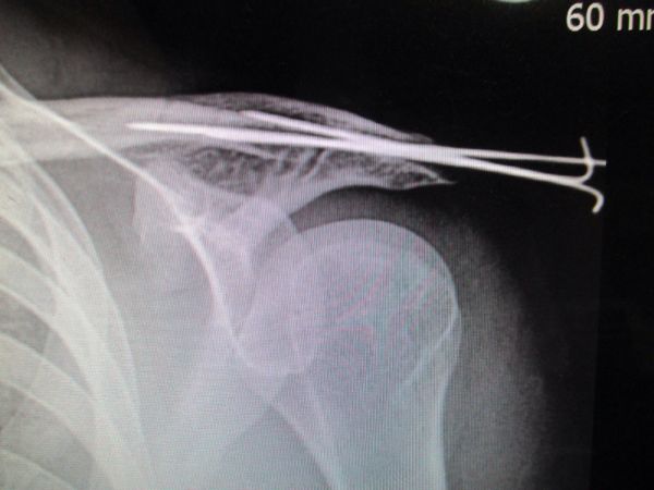 怪我 競馬騎手修行ブログ 藤井勘一郎 海外ベース日本人ジョッキー 楽天ブログ