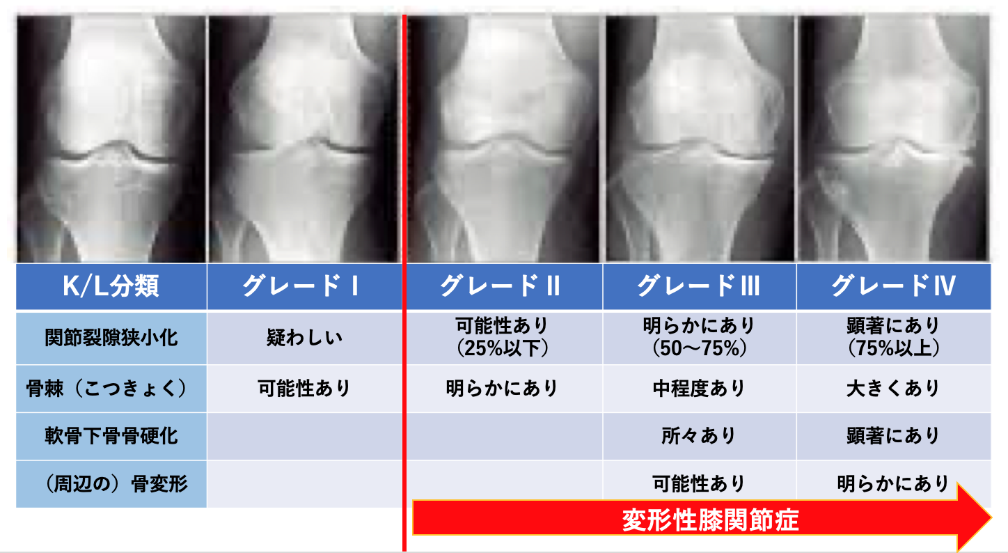 内側区画変形性関節症の症状は何ですか?