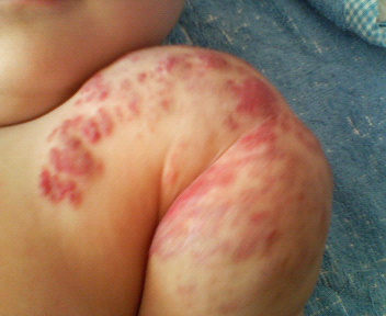 いちご状血管腫