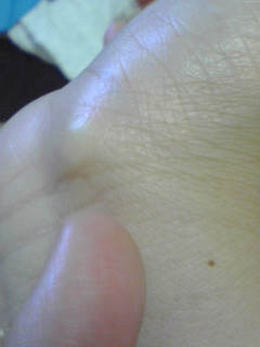 写真よりももっとぼっこり出ています