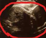 妊娠28週目のエコー画像