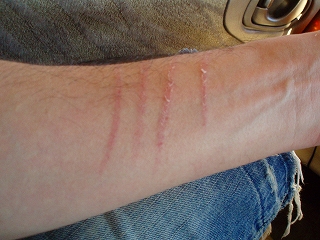 クマとの格闘の傷跡