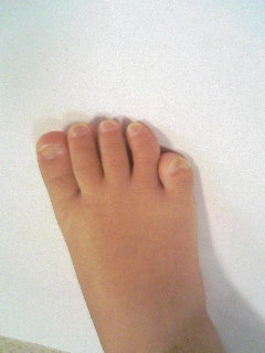 手術1週間前　２