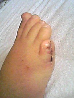 術後２週間　抜糸直後２