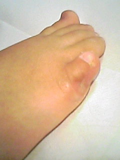 術後１ヶ月　患側