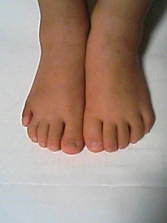 術後１ヶ月　両側