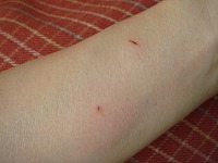 ちびちびくんに噛まれた・・