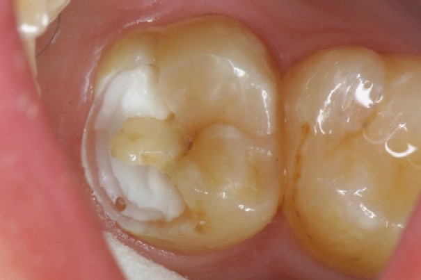 虫歯4