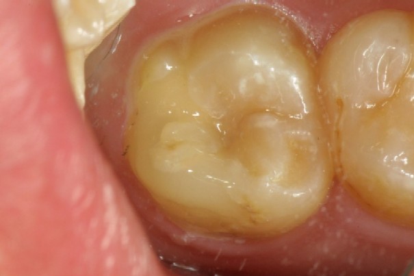 虫歯5