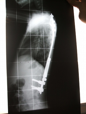 レントゲン（Ｈ18．1/30）側面