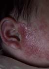 アトピー皮膚症状　３ヶ月