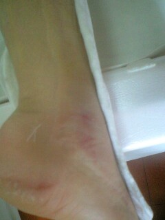 アキレス腱断裂受傷後4日目