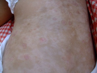 急性痘瘡状苔癬状粃糠疹 ケイのお部屋 楽天ブログ