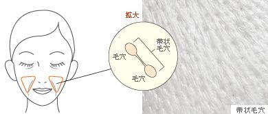 毛穴同士が小ジワで結ばれた状態