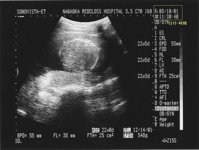 超音波写真の見方 ママナビ 妊娠 出産 育児の情報サイト 楽天ブログ