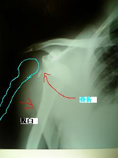 4脱臼骨折.JPG