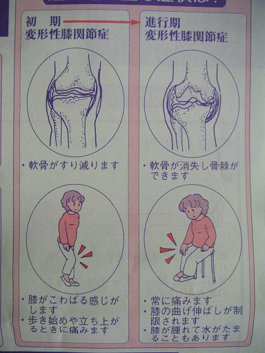 変形性膝関節症.JPG
