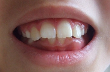 歯1