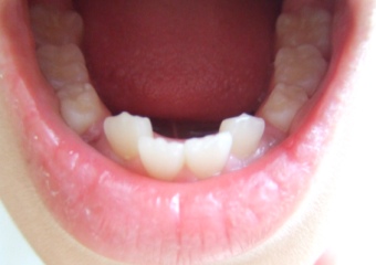 歯2