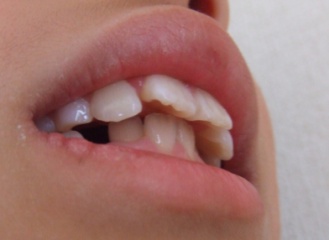 歯3