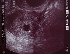 妊娠５週 １日目 胎嚢確認 バナジタイム 楽天ブログ
