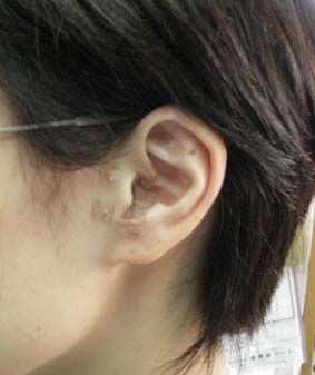 耳ポイント施術