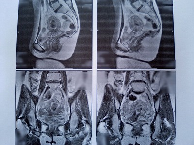 MRI画像-2
