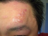 帯状疱疹２