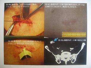 ポート挿入手術と挿入後の画像