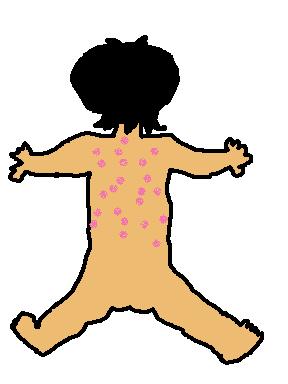 突発性湿疹後ろ１