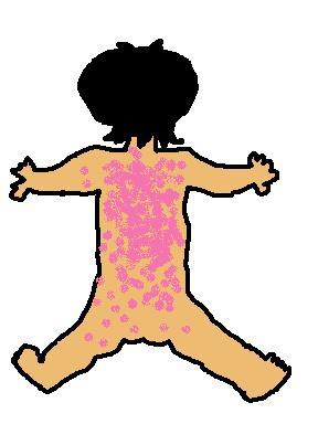 突発性発疹後ろ２