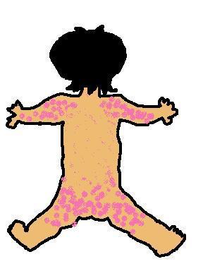 突発性発疹後ろ４