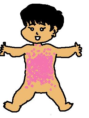 突発性発疹前２