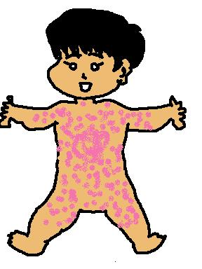 突発性発疹前３