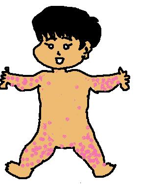 突発性発疹前４