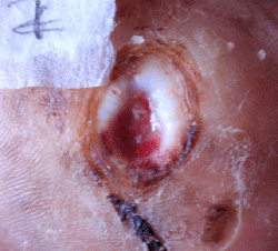 糖尿病性足腫瘍２