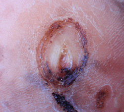 糖尿病性足腫瘍３