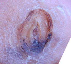 糖尿病性足腫瘍４