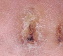 糖尿病性足腫瘍５