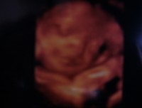 ３Ｄ写真（２７週４日）