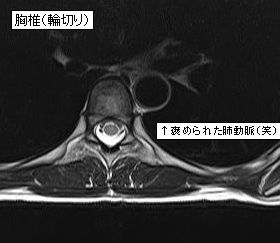 ＭＲＩ・肺動脈。