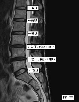 ＭＲＩ・腰椎。