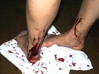 ヤマビルに吸血された足
