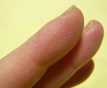 ハンドマスク使用前の手荒れ具合