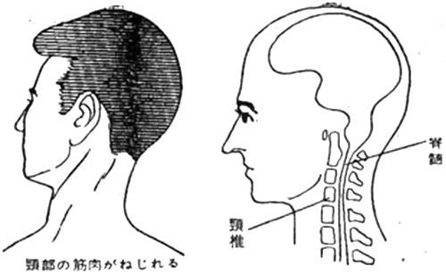 むちうち症の指圧ポイント