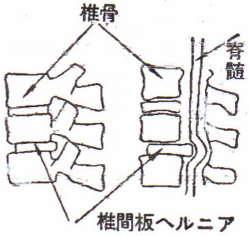 椎間板ヘルニア断面図